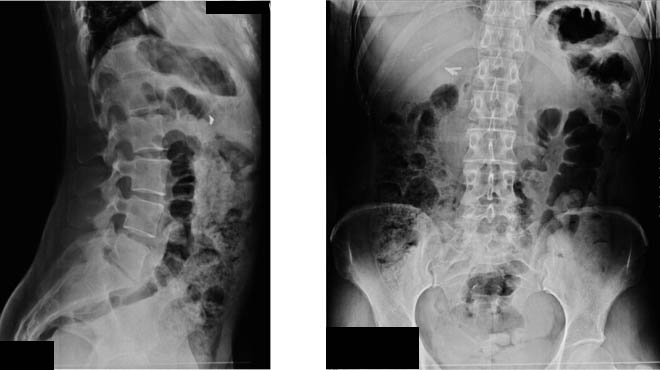 Prima - Cura Dolore Lombare